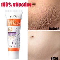 Stretch Marks Permanent Removal Cream - Skin Repair and Firming Care